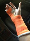 Broken_right_hand_in_orange_cast.jpg